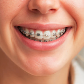 A Complete Guide to Traditional Metal Braces